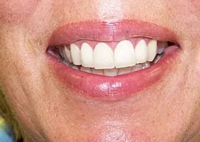 A set of teeth after cosmetic dentistry treatments at TRUST dental