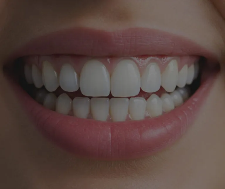 Veneers