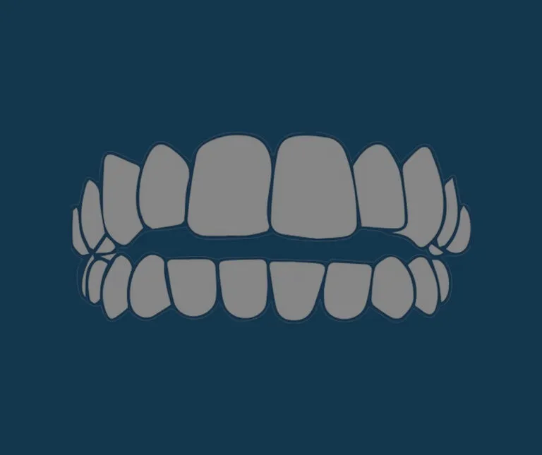 Orthodontic Aligners