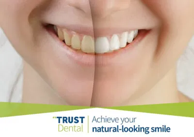 How to achieve your natural-looking smile