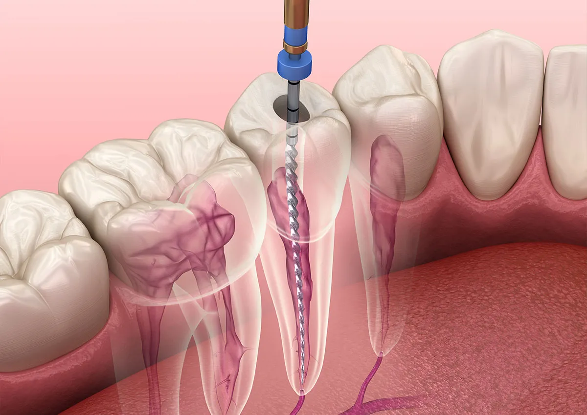 A dentistry diagram showing a root filling treatment