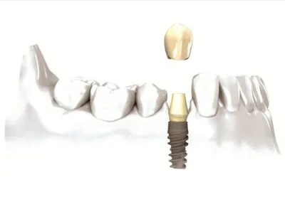 Considering dental implants? Grab the opportunity with both hands!