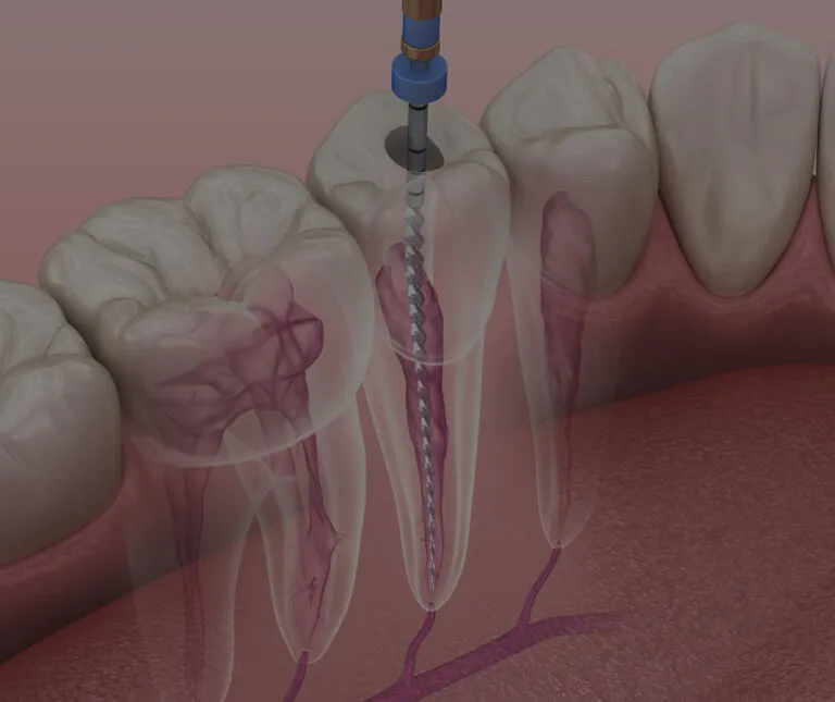 A dentistry diagram showing a root filling treatment