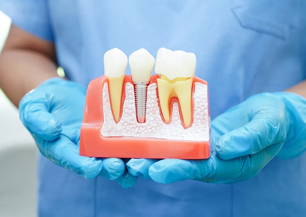 Dentist showing a model of dental implants 