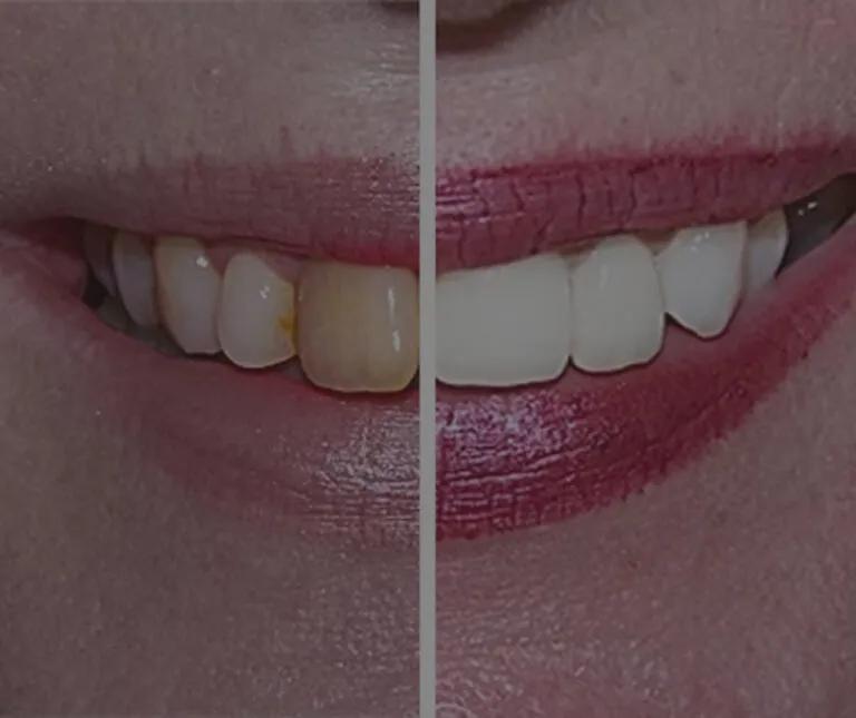 An example of Teeth Whitening at Trust Dental