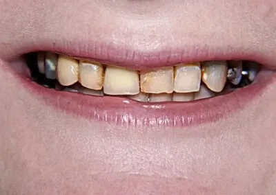 A set of teeth before teeth whitening treatments at TRUST dental