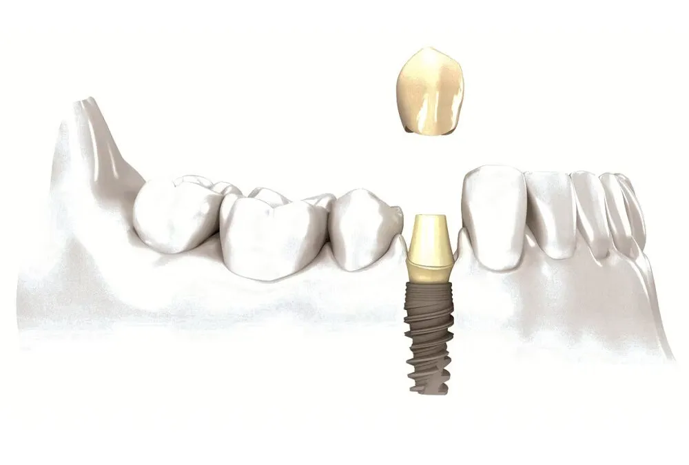 Considering dental implants? Grab the opportunity with both hands!