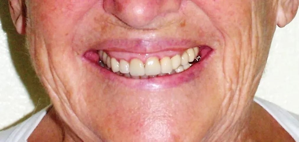 Close of up a dentistry clients new teeth 