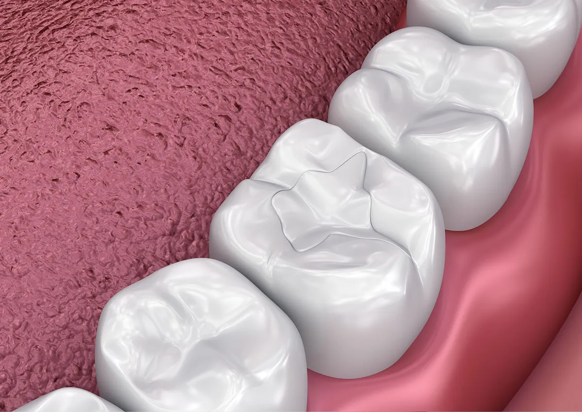 A dental diagram showing a white filling