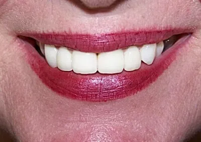 After cosmetic dentistry treatments at TRUST dental