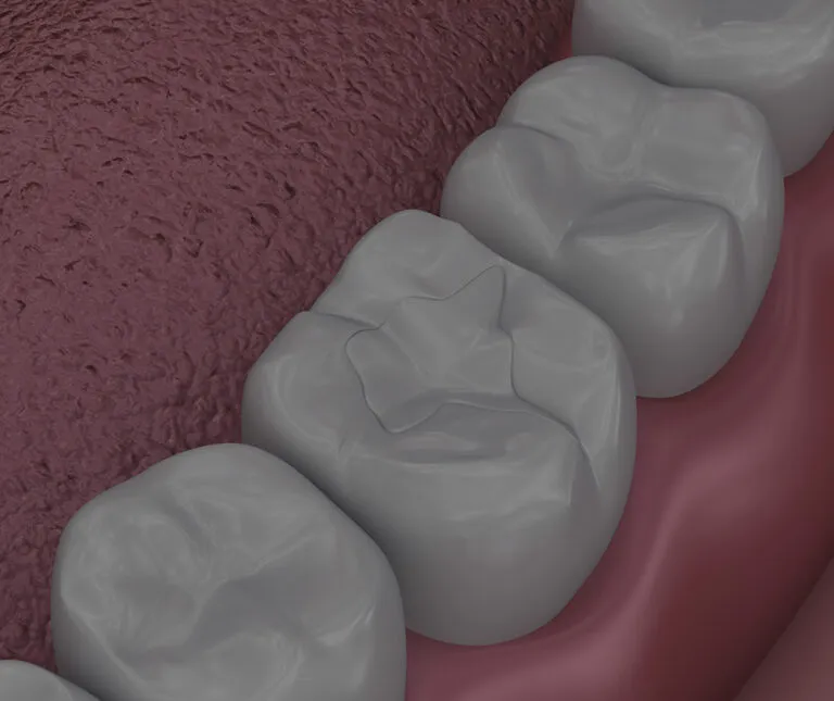 A dental diagram showing a white filling