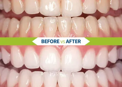 Thinking about a brighter, whiter smile?