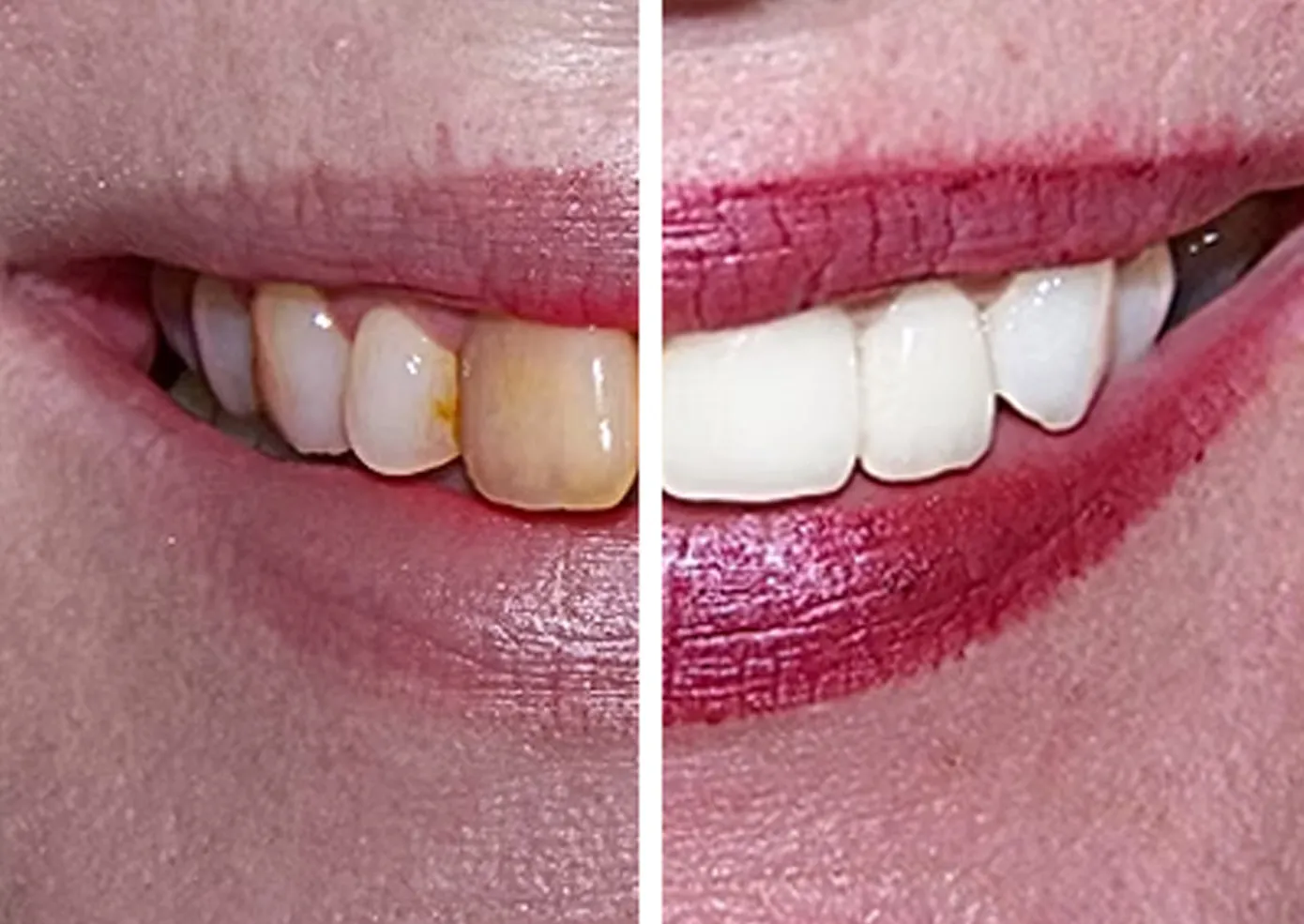 Trust dental before and after teeth whitening